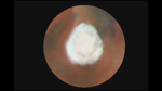 Seasonal Changes in the Martian North Polar Ice Cap