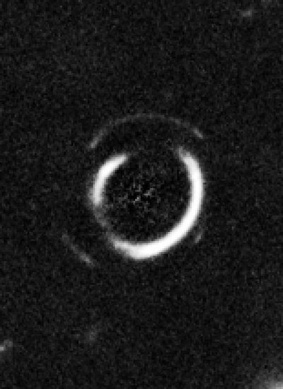 Gravitational Lens System SDSSJ0946+1006 (Zoom onto Double Einstein Ring)